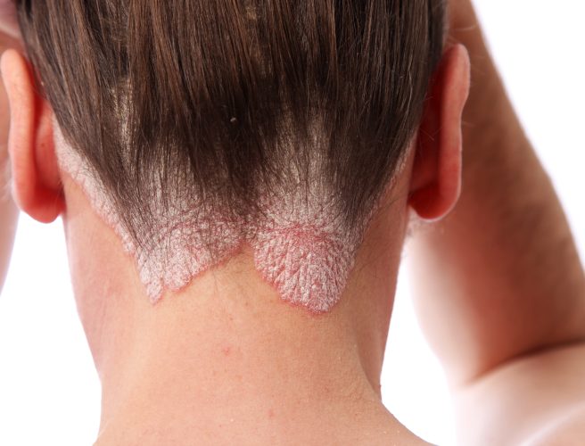 psoriasis on neck